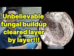 Unbelievable fungal buildup cleared layer by layer | ear cleaning | ASMR earwax | soothing |relax|