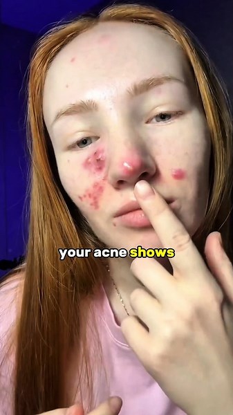 Your Acne Location Might Be Telling You Something 😳