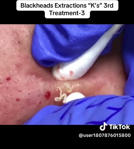 Blackheads Extractions “K’s” 3rd Treatment-3