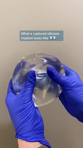 What a ✨ruptured silicone implant✨ looks like! This implant was removed from one of our patients a couple weeks ago! We get many questions regarding what happens when the unfortunate instance of a ruptured implant occurs. As you can see in the clip above, even when a silicone implant ruptures its contents continue to usually remain inside the implant! To answer any further questions regarding your implants, or if you are concerned that your implant has ruptured feel free to give our office a cal