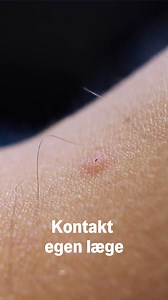 Sådan skal du gøre, hvis du bliver bidt af en flåt 🪲 Hvis du bliver bidt af en flåt, kan du risikere at blive smittet med Borrelia eller TBE-virus. Derfor er det vigtigt, at fjerne flåten hurtigt. Du kan se i videoen, hvad du skal gøre. Søg læge hvis: 📍 Du er blevet bidt af mange flåter samtidig 📍 Du får et rødt udslet på størrelse med en femkrone, der hvor flåten har bidt 📍 Du bliver sløj og utilpas med influenzalignende symptomer Hvis du er kommet hjem fra et sted med, hvor flåterne kan ha