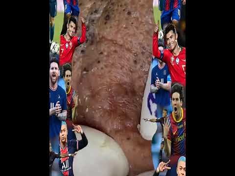 Blackheads Removal | Acne Treatment and Very Satisfying Satisfying Pimple pop #blackheads