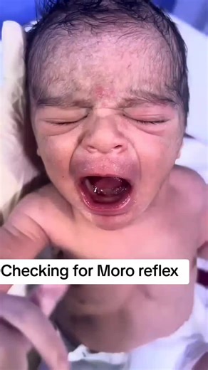 Understanding the Moro Reflex in Newborns