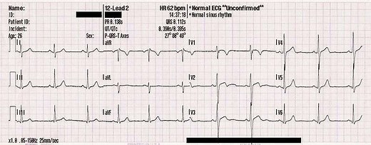 Définition | Variabilité de la fréquence cardiaque : qu'est-ce que c'est ? | Futura santé