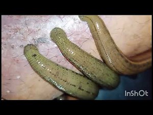 Leech therapy mode of action |Leech Therapy: How It Works - Local vs Systemic Action Explained