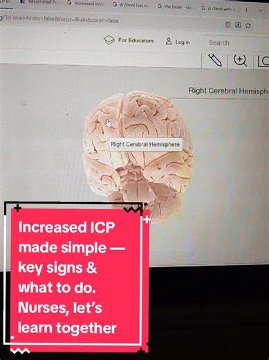 Increased ICP made simple — key signs & what to do. Nurses, let’s learn together @Nurse Sarah @Nurse Mike @ SimpleNursing #nursetok #fypage #medschool