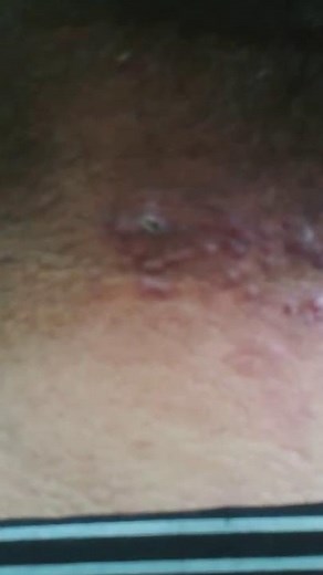 Folliculitis keloidalis nuchae