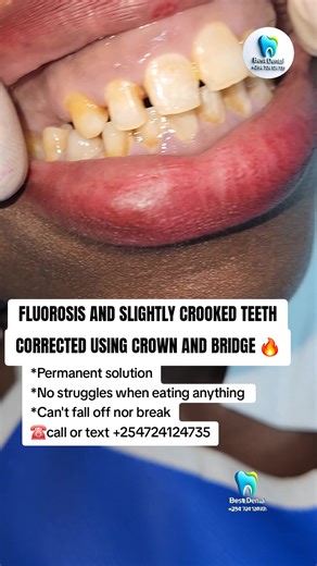 Crown and Bridge Method for Permanent Teeth Replacement