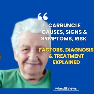 A carbuncle is a painful and serious skin infection that develops...