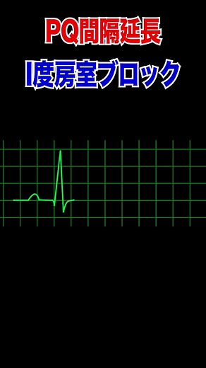 房室ブロックの理解と心電図の分析