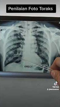 Foto Toraks yang berbeda | penyakit PPOK atau COPD dan susp TB paru DD pneumonia | rontgen paru