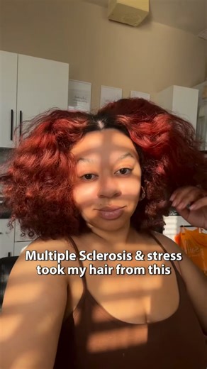 Multiple sclerosis and stress have both led to hair loss. From as young as I remember I’ve always been ‘the mixed race girl with Afro hair’ you could even say my Afro became part of my identity. Since I got medicated for MS my hair has completely changed even to the curl pattern. This is all due to hormonal changes, immune system, lack of health / vitamins, stress weakening follicles which in turn triggers excessive shedding. I could talk about the scientific terms like cortisol and trichotillom