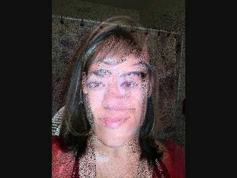 Before and after double jaw surgery(Acromegaly)