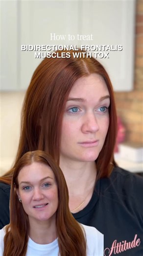 INJECTABLES | SKINCARE | MED SPA | CHICAGO on Instagram: "Ever noticed someone raising their brows and their whole scalp seems to move too? That’s because of something called a bidirectional frontalis. Unlike the more straightforward unidirectional muscles, the fibers of this one muscle can sometimes pull in opposite directions, which means when a patient tries to move just their forehead, the movement travels farther, sometimes into the scalp & hairline. For patients, this explains why certain 