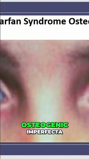 Blue Sclera: Identifying Marfan Syndrome & Related Conditions #shorts