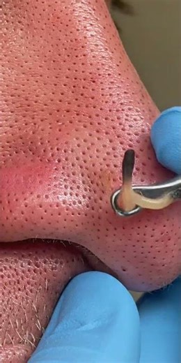 Rhinophyma Ultra-Slow Extraction #automobile #Rhinophy