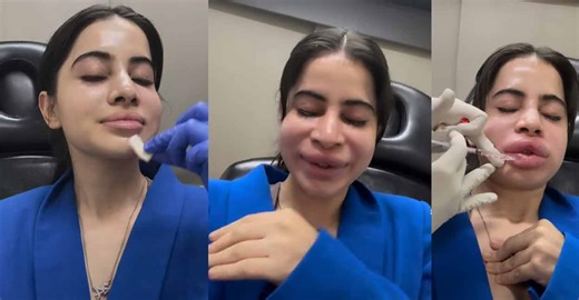 Uorfi Javed's lip fillers: What are the risks of the treatment