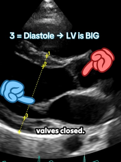 You will never forget systole vs diastole again. 3️⃣ When it’s BIG 2️⃣ When it’s SMALL Simple. Clean. Registry ready. 🫀 Full protocols & breakdowns on YouTube: Echo Classroom. #echostudent #cardiacsonography #echotech #ardms #registryprep