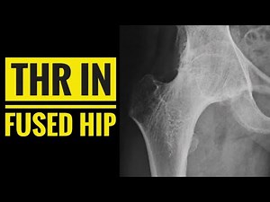 Total Hip Replacement in Fused/ Ankylosed Hip