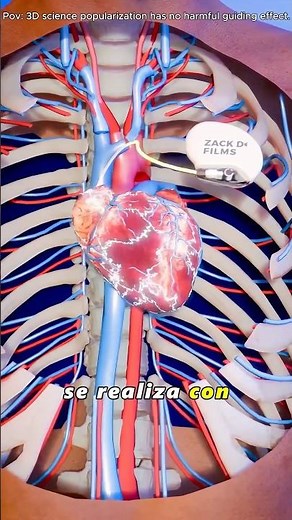 "How Pacemaker Insertion Procedure Is Performed (3D Animation)#pacemaker#heartsurgery"
