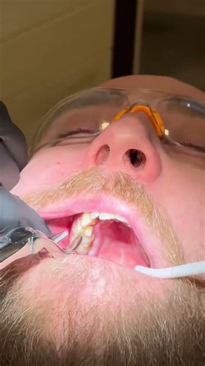 Extraction of upper wisdom tooth in 25 seconds #oralsurgery #extractions #teaching #dentalschool #d