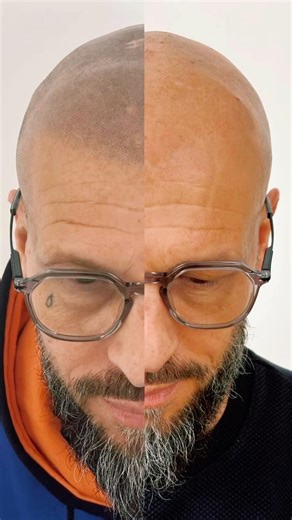 Nouveau résultat effet rasé naturel Tricopigmentation #dermopigmentation#micropigmentation #smp