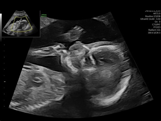 Ana Luiza Barros Kullberg | Det finns inga ord som kan beskriva vår glädje. Mamma och pappa älskar dig så mycket, min älskling! 💗🌈 | Instagram