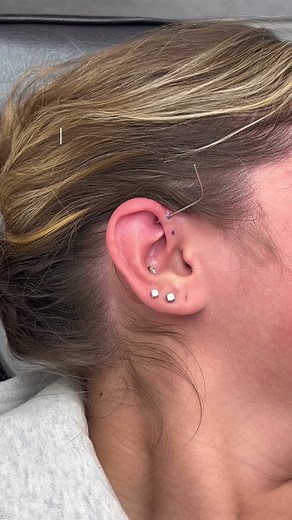 Double Forward Helix Piercings: A Stylish Ear Transformation