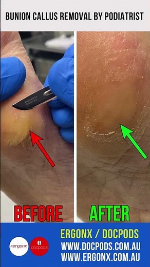 Easy Bunion & Callus Removal: Watch a Podiatrist's Expert Technique #Podiatry #FootCare