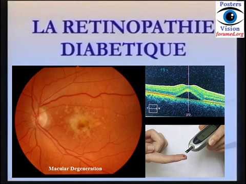 Rétinopathie diabétique: définition physiopathologie Classification