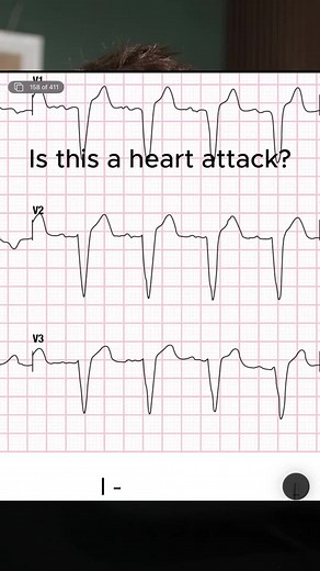 Identifying Heart Attacks: Understanding ST Elevation