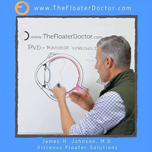 1.2K views · 18 reactions | A posterior vitreous detachment PVD is a...