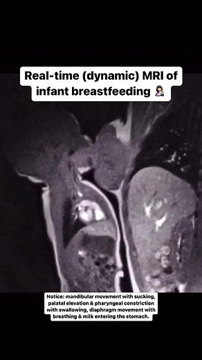 Real-time MRI imaging was successful in capturing dynamic images of the breastfeeding swallow! This imaging modality confirms the dorsal surface of the infant's tongue elevates the maternal nipple to the hard palate, closing the space around the nipple with no air visible in the oral cavity during sucking and swallowing. Breastmilk was easily visualized, being high intensity on T2 sequences. Simply incredible Ph.D. research by Dr. Nikki Mills, of University of Aukland, New Zealand. These images 