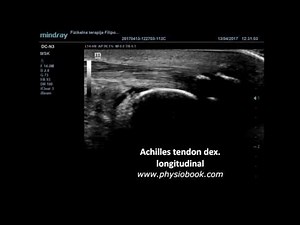Achilles calcification (tendinitis calcificans, Haglund syndrome - MSK ultrasound