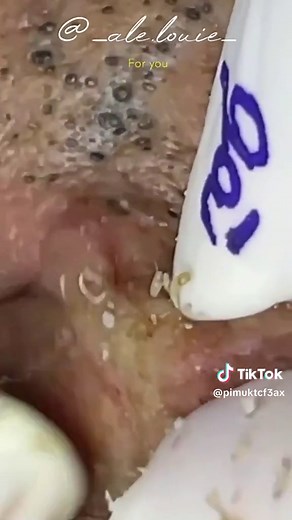 Understanding Skin Conditions: Infected Blister on Arm