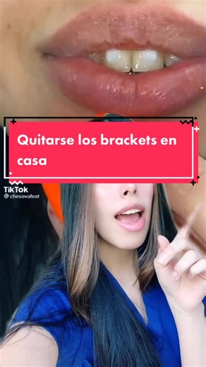Cómo quitar los brackets en casa de forma segura