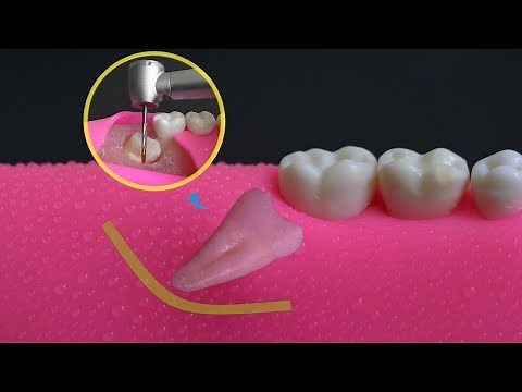 Mesioangular Impacted Wisdom Tooth Removal | All Steps In 4K.