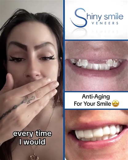 Want a perfect smile without the dentist visit? Meet Shiny Smile Snap-On Veneers — custom, non-invasive, and designed to snap into place in seconds. ✅ Hide gaps, stains, crooked or missing teeth ✅ No drilling, no adhesives, no pain ✅ Eat, talk, and flash your new smile with confidence ✨ Limited-time: 40% off 0% financing Click to see how easy it is to transform your smile. | Peak Health Today