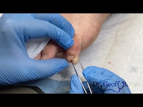Removal of an osteochondroma on the toe