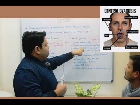 Cyanosis Examination for medical Students : Peripheral V/S Central cyanosis #cyanosis #examination