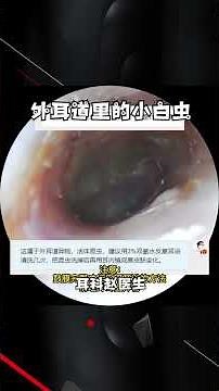 A small white bug in the ear,外耳道里的小白虫