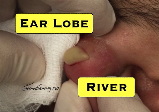Earlobe Cyst Popping and Drainage