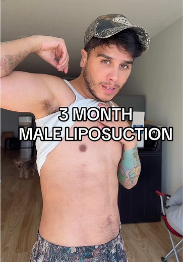 3-Month Male Liposuction Update: Results & Recovery