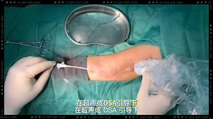 PTA手术速览：一看就懂，快速打通生命线！