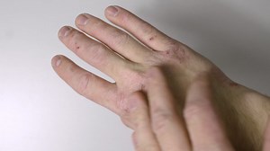 Caucasian Hands With Psoriasis Or Eczema Sickness - Hand Skin Disease Concept - Close Up Shot | Premium Stock Video Footage