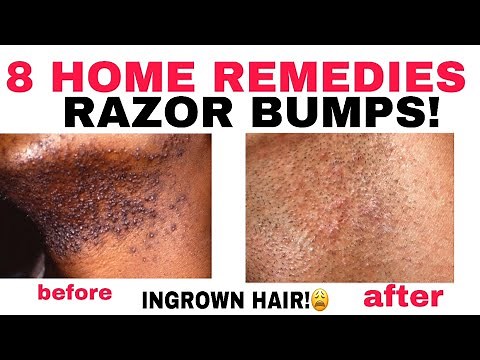 8 HOME REMEDIES TO STOP INGROWN HAIRS or RAZOR BUMPS! Aloe vera honey baking soda:D&N Medical Series