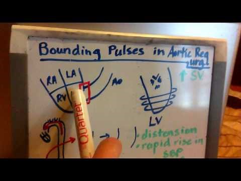 Bounding Pulses in Aortic Regurgitation