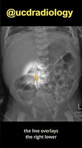 Umbilical catheters on radiographs
