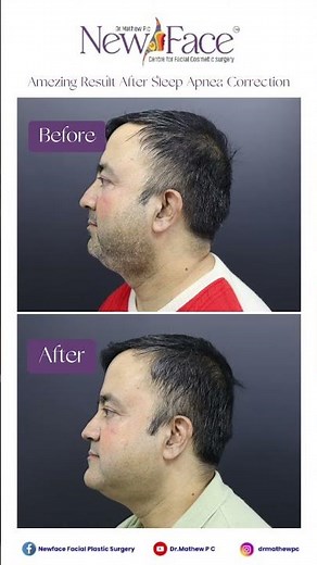 Jaw Surgery Before & After | Life-Changing Transformation at Newface