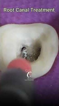 Dental Makeover Animation | Cavity Removal, Crown Placement & Root Canal Explained